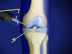 arthroscopy knee